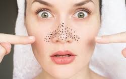 Natural Treatment for Blackheads